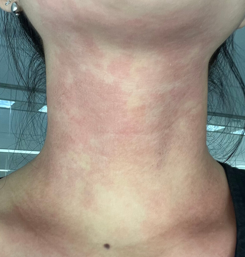 엘리델 크림 사용 후 발생한 접촉성 피부염