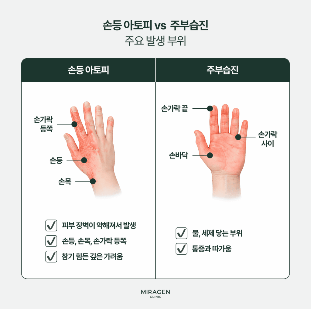 손등 아토피와 주부습진의 주요 발생 부위
