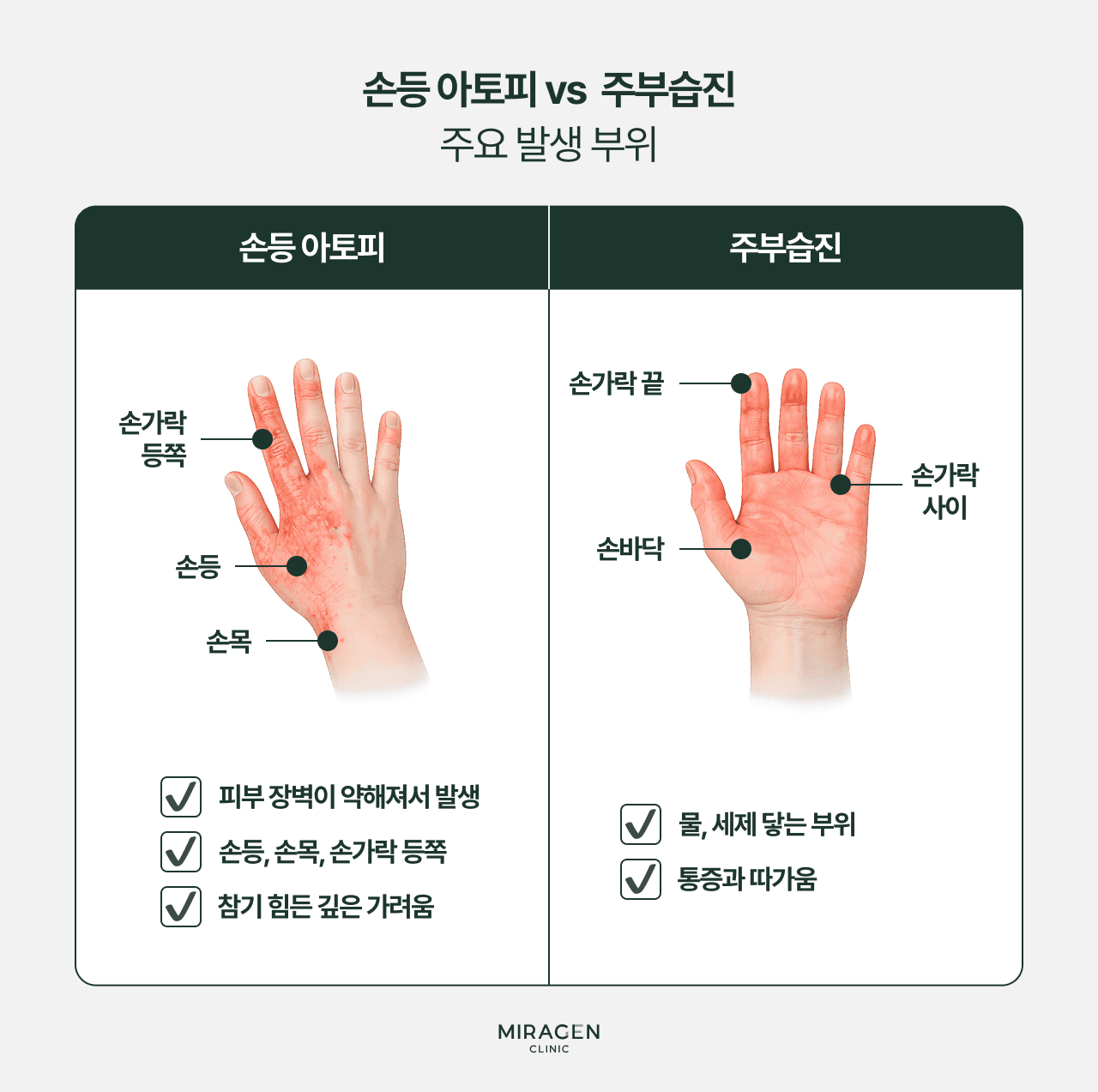 손등 아토피와 주부습진 구별법