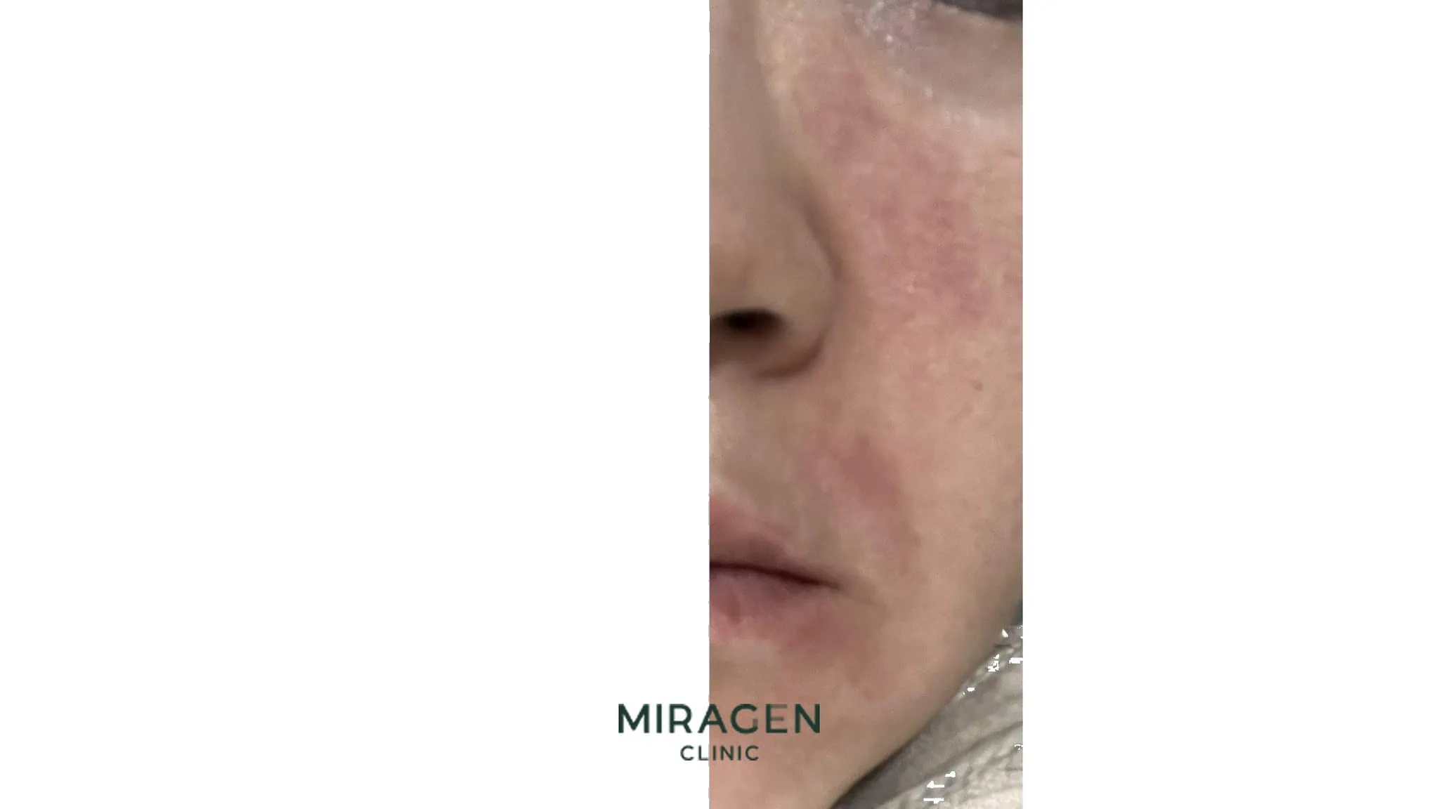 프로토픽 사용 후 볼 부위에 미만성 홍반이 생긴 안면 피부염 환자의 임상 사진