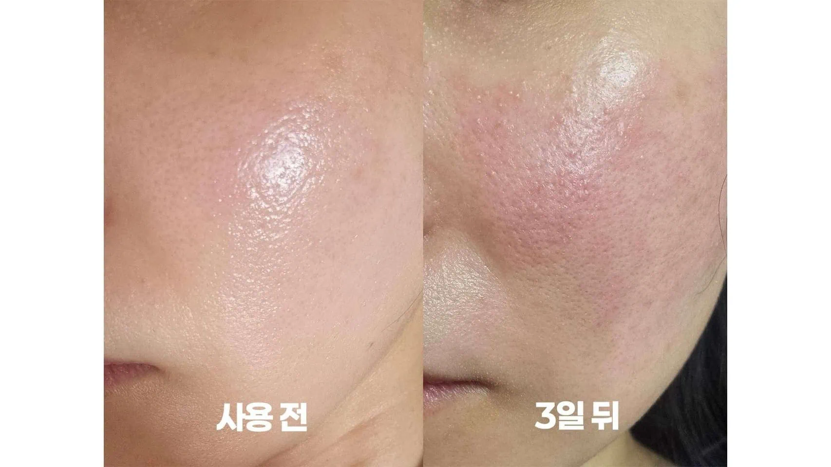 수란트라 사용 3일 후 초기 악화 이버멕틴(수란트라) 크림 도포 전과 3일 후 동일 환자의 볼 부위를 비교한 임상 사진으로, 모낭충 사멸에 따른 초기 악화 반응이 관찰됨