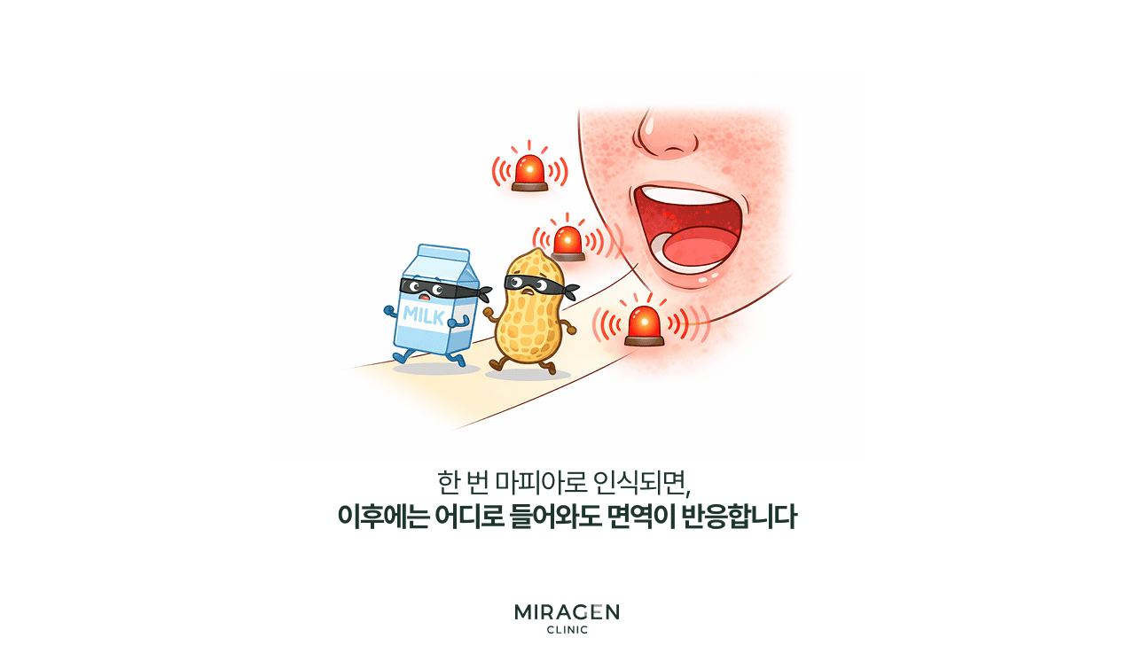 알레르겐 면역반응 메커니즘 한 번 마피아로 인식된 우유 · 땅콩이 도둑 마스크를 쓰고 입으로 침투하며 면역 경보가 울리는 장면으로, 피부 장벽 손상 후 음식 알레르기가 전신으로 확산되는 과정을 설명하는 일러스트