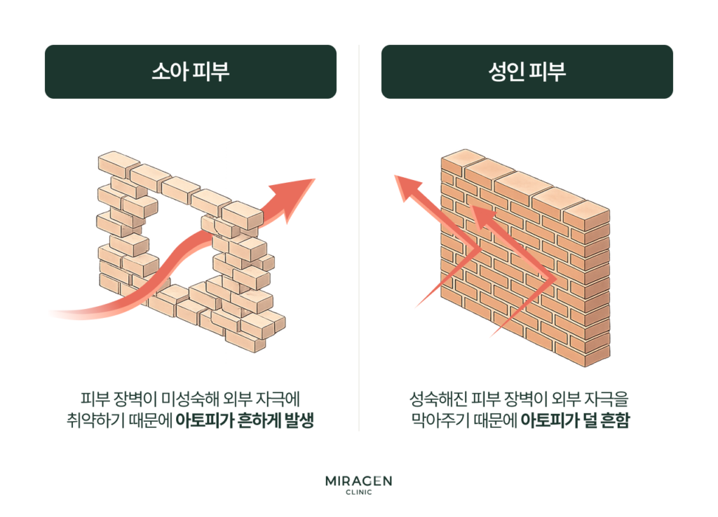 소아와 성인의 피부 장벽을 벽돌담으로 비교한 인포그래픽으로, 소아는 미성숙한 장벽으로 자극이 쉽게 통과하고 성인은 튼튼한 장벽이 자극을 차단하여 아토피가 소아에게 흔한 이유를 설명
