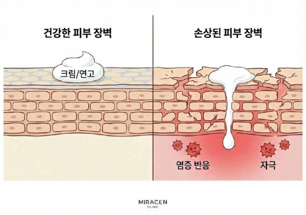 피부 장벽이 손상됐을 때 프로토픽(타크로리무스)·엘리델(피메크로리무스)이 과량 흡수되어 접촉성 피부염을 일으킬 수 있음을 보여주는 인포그래픽
