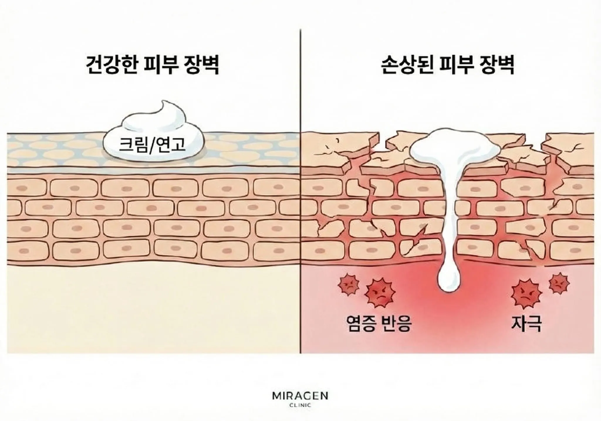 피부 장벽 손상 시 엘리델 과흡수 엘리델 사용 시 건강한 피부 장벽과 손상된 피부 장벽에서 외용제 침투와 자극 반응 차이를 비교한 피부 단면 일러스트