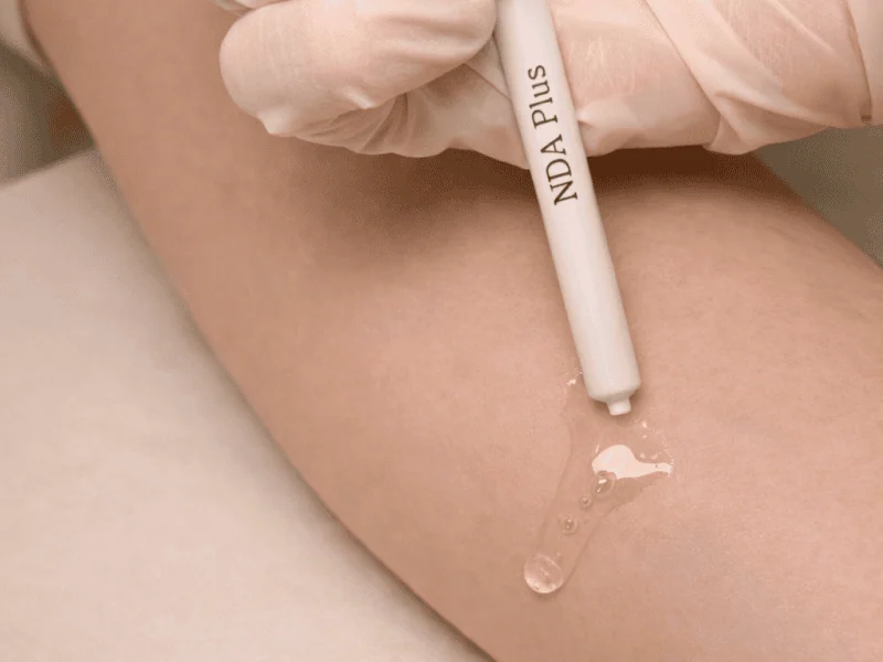 아토피 첫 방문에서 손상된 피부 장벽을 보호하기 위해 펜형 어플리케이터로 투명 액상 창상피복재를 팔 안쪽 피부에 도포하는 시술 장면으로 장벽 회복을 돕는 치료 과정입니다
