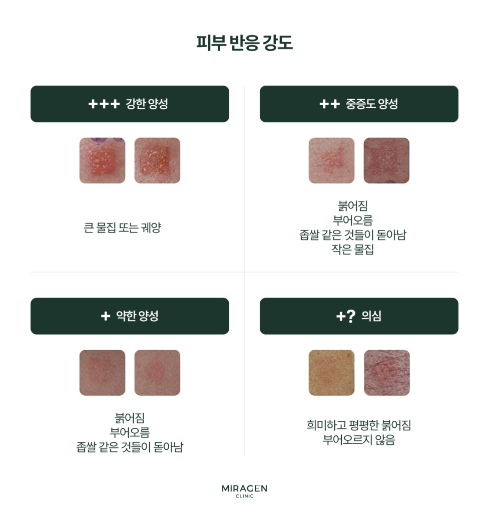 첩포 검사 결과 판독 기준표 — 반응 강도에 따른 음성(−)·의양성(±)·양성(+~+++) 등급 분류 인포그래픽