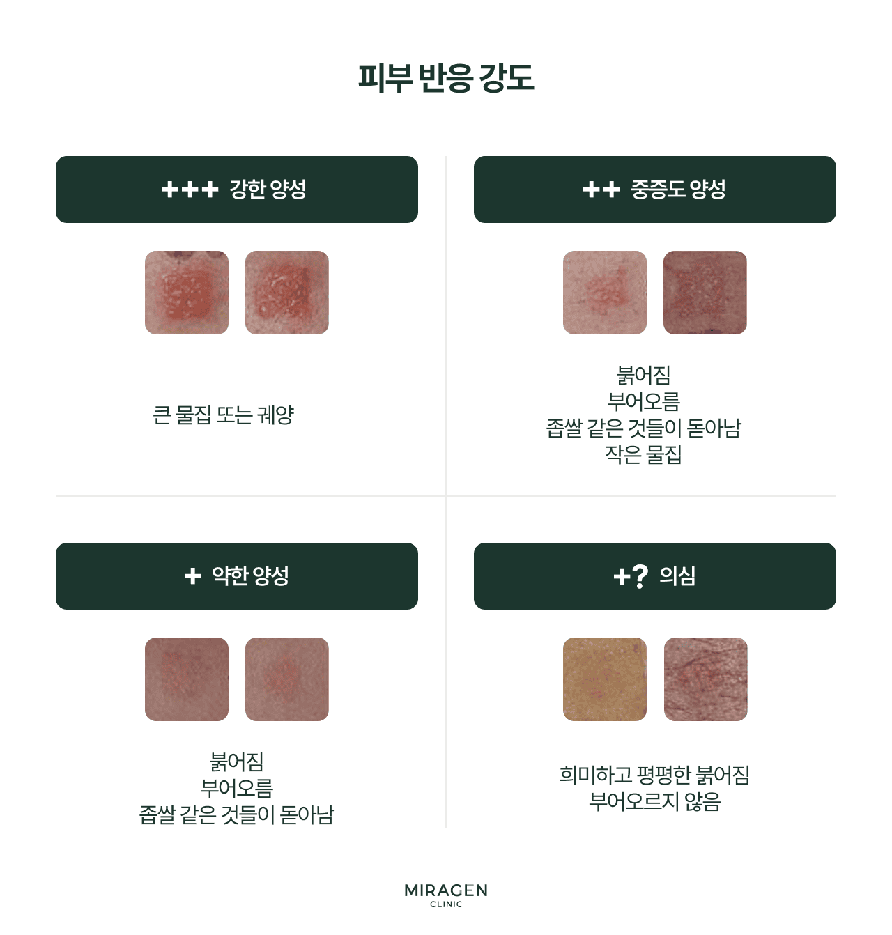 첩포 검사 결과 판독 기준표 — 반응 강도에 따른 음성(−) · 의양성(±) · 양성(+~+++) 등급 분류 인포그래픽