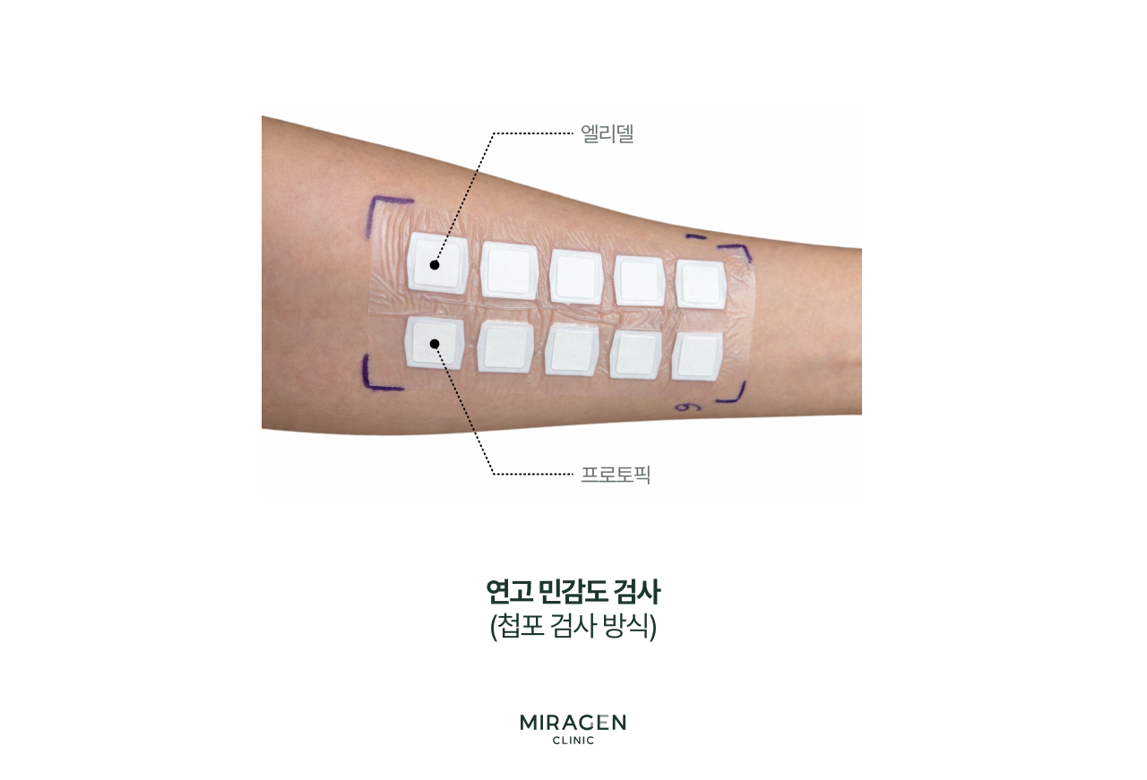 팔 안쪽에 프로토픽과 엘리델 연고 패치를 부착한 첩포 검사 사진으로, 비스테로이드 면역억제 연고에 대한 접촉성 피부염 발생 여부를 사전에 확인하는 피부 민감도 검사 과정을 보여줌