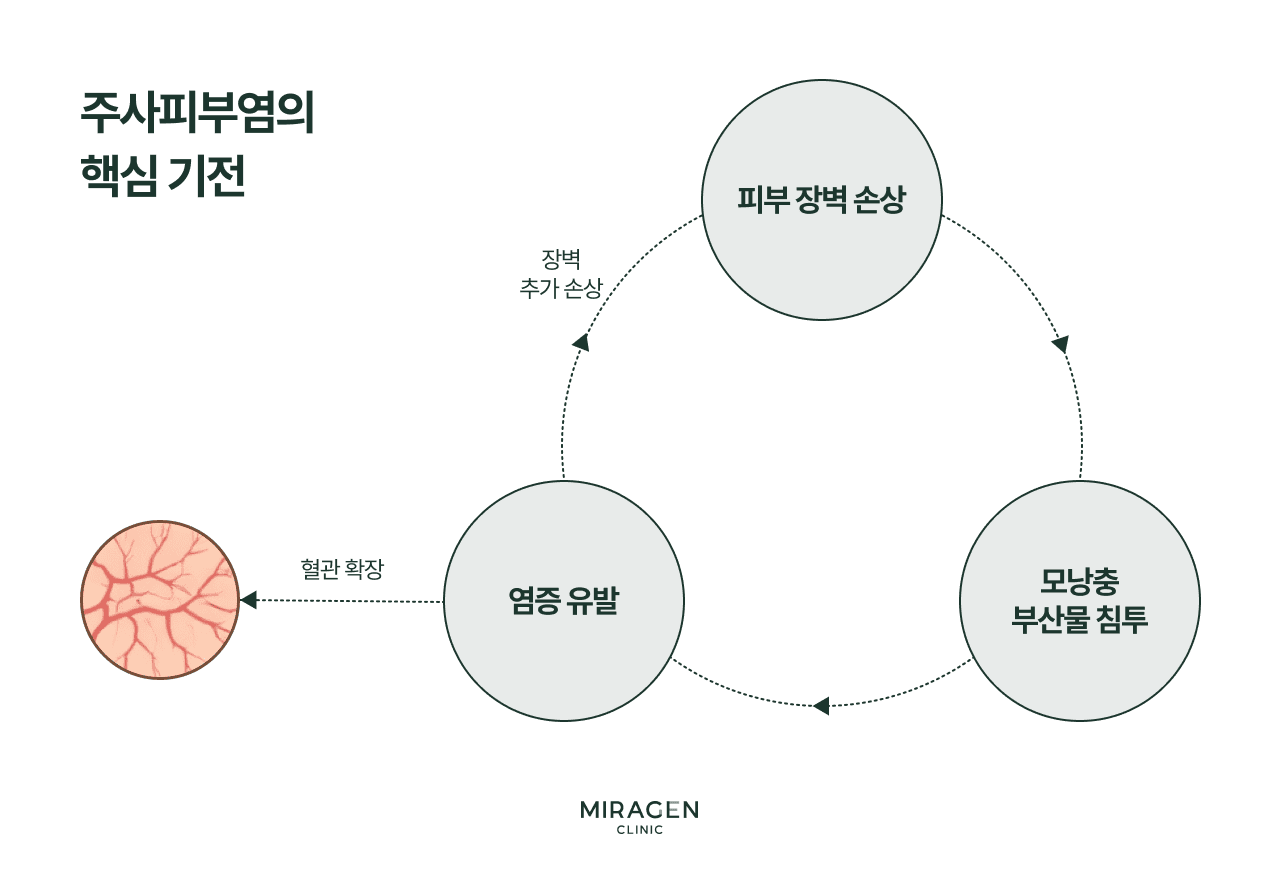 주사피부염 핵심기전 장벽손상 악순환 주사피부염 핵심 기전을 나타낸 순환 다이어그램으로 피부 장벽이 손상되면 혈관이 확장되고 모낭충 부산물이 침투하여 염증이 유발되며 염증이 장벽을 다시 손상시키는 악순환 구조를 보여줍니다