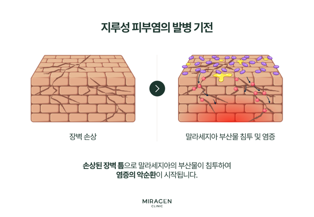 손상된 피부 장벽 틈으로 말라세지아의 대사산물이 침투해 염증을 유발하고, 염증이 장벽을 추가로 손상시키는 악순환 기전을 단계별로 보여주는 지루성피부염 발병 메커니즘 인포그래픽