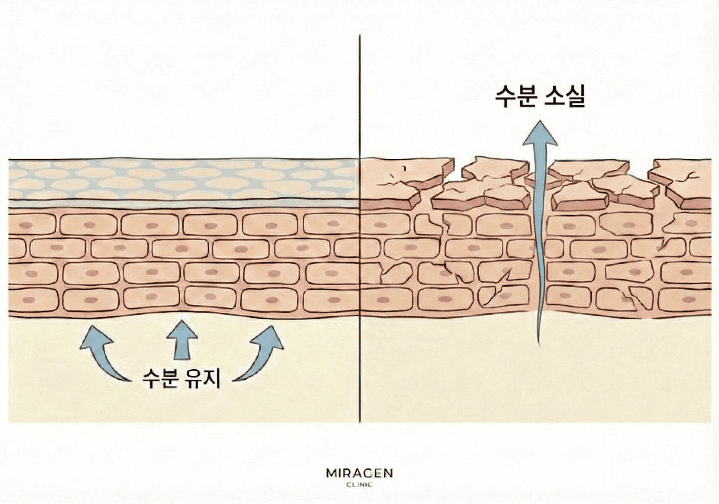 유황비누의 높은 pH(9~10)가 피부 장벽을 손상시켜 수분이 빠져나가고 건조해지는 과정을 정상 피부 장벽과 비교한 일러스트