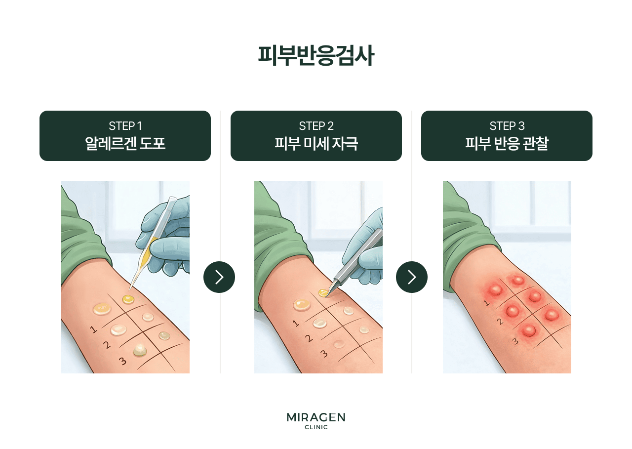 예전에 MAST 혈액검사 대신 사용됐던 피부반응검사의 과정을 보여주는 인포그래픽