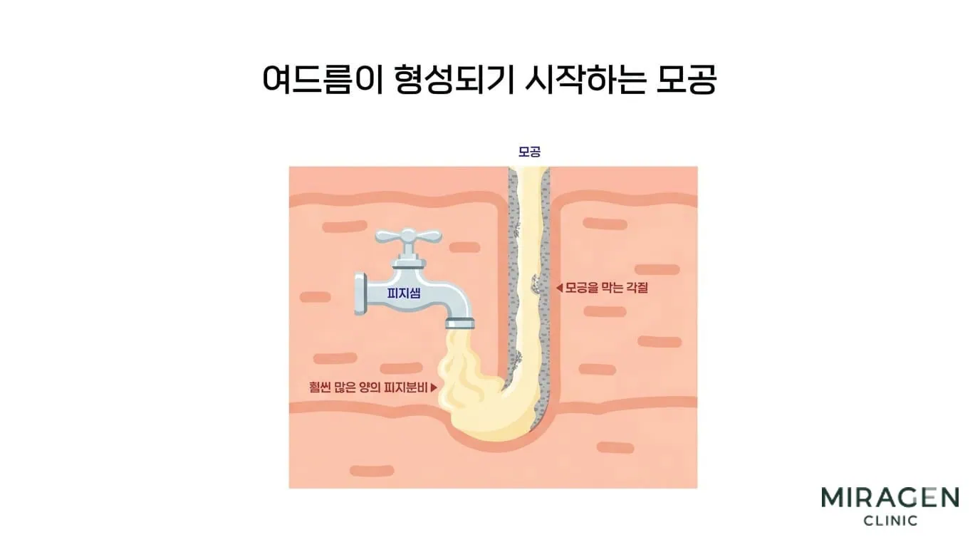 모공이 막히기 시작하는 단계 여드름이 형성되기 시작하는 모공 단면 일러스트로 각질이 모공을 막고 피지가 과다 분비되어 축적되는 과정을 수도꼭지 비유로 표현