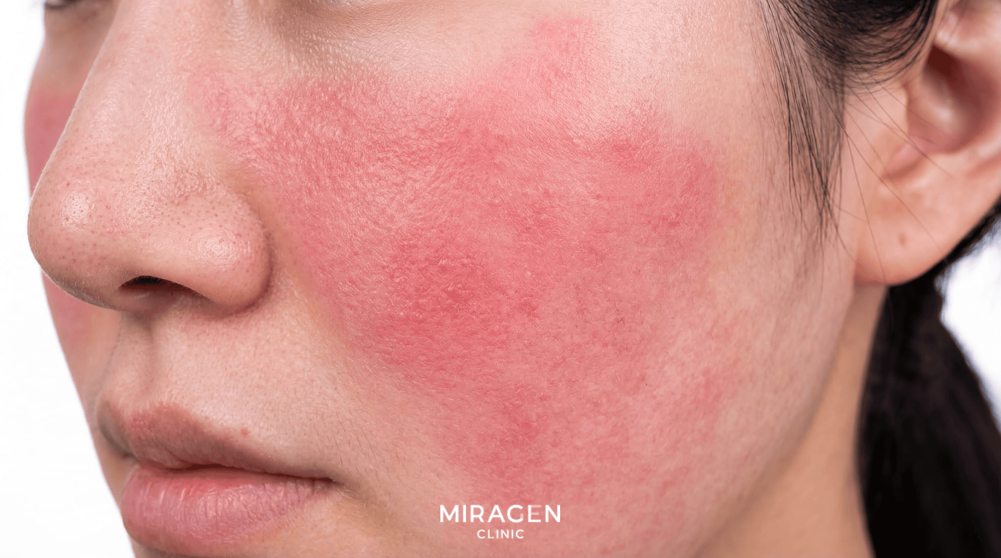 韩国女性特应性皮炎患者面颊的近距离临床照片，面部潮红并有明显热感，红斑大范围扩散