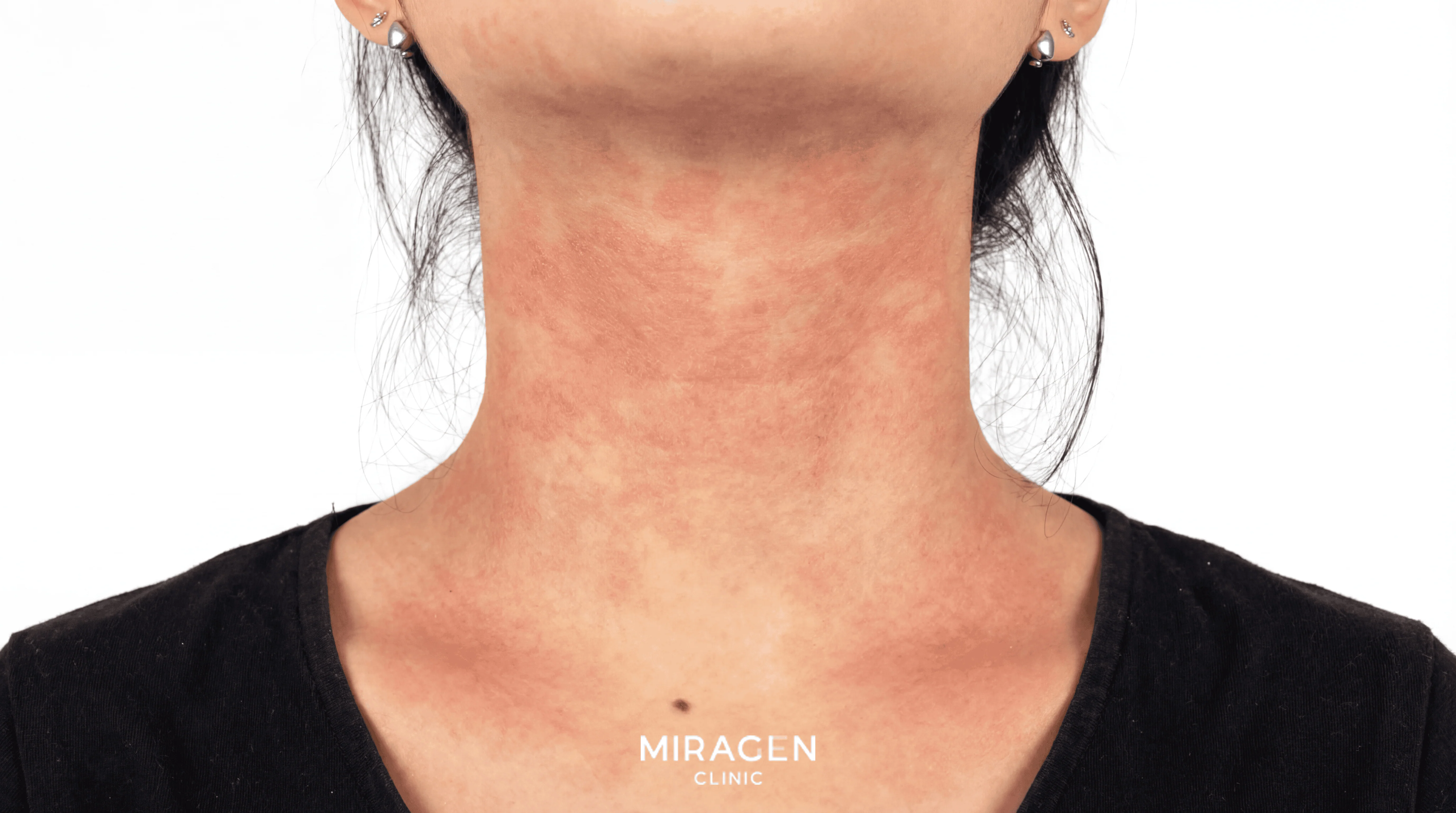 엘리델 사용 후 목 전면과 양측에 홍반성 접촉 피부염이 발생한 한국인 여자 환자의 16대9 임상 사진으로, 붉은 발진과 염증 분포를 보여주는 이미지