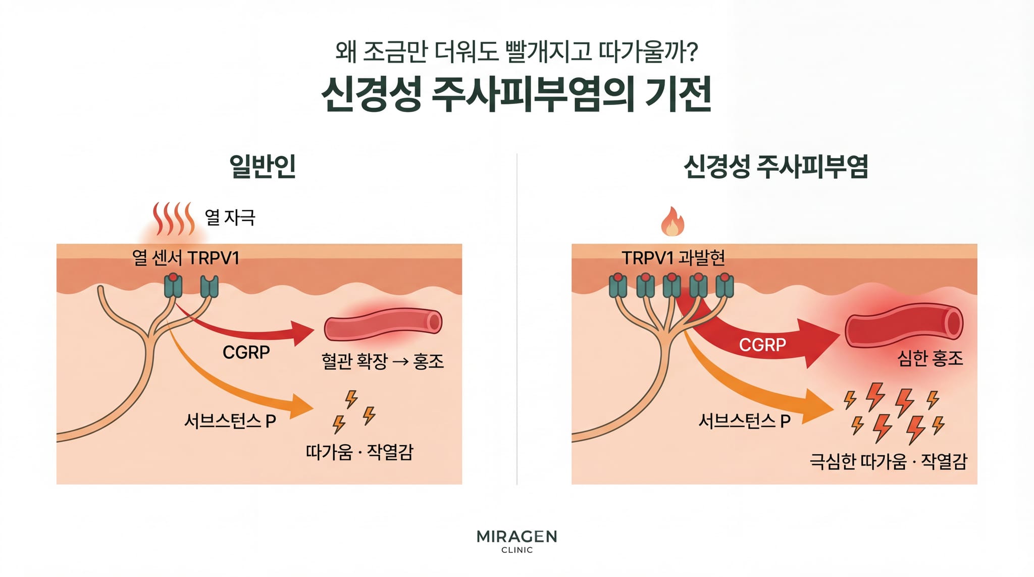 신경성 주사피부염의 기전을 보여주는 일러스트. 왼쪽은 정상 피부에서 열 자극이 TRPV1 수용체를 활성화해 CGRP와 서브스턴스 P를 방출하는 과정, 오른쪽은 TRPV1이 과발현된 피부에서 같은 자극에 훨씬 강한 홍조와 작열감이 발생하는 과정을 비교