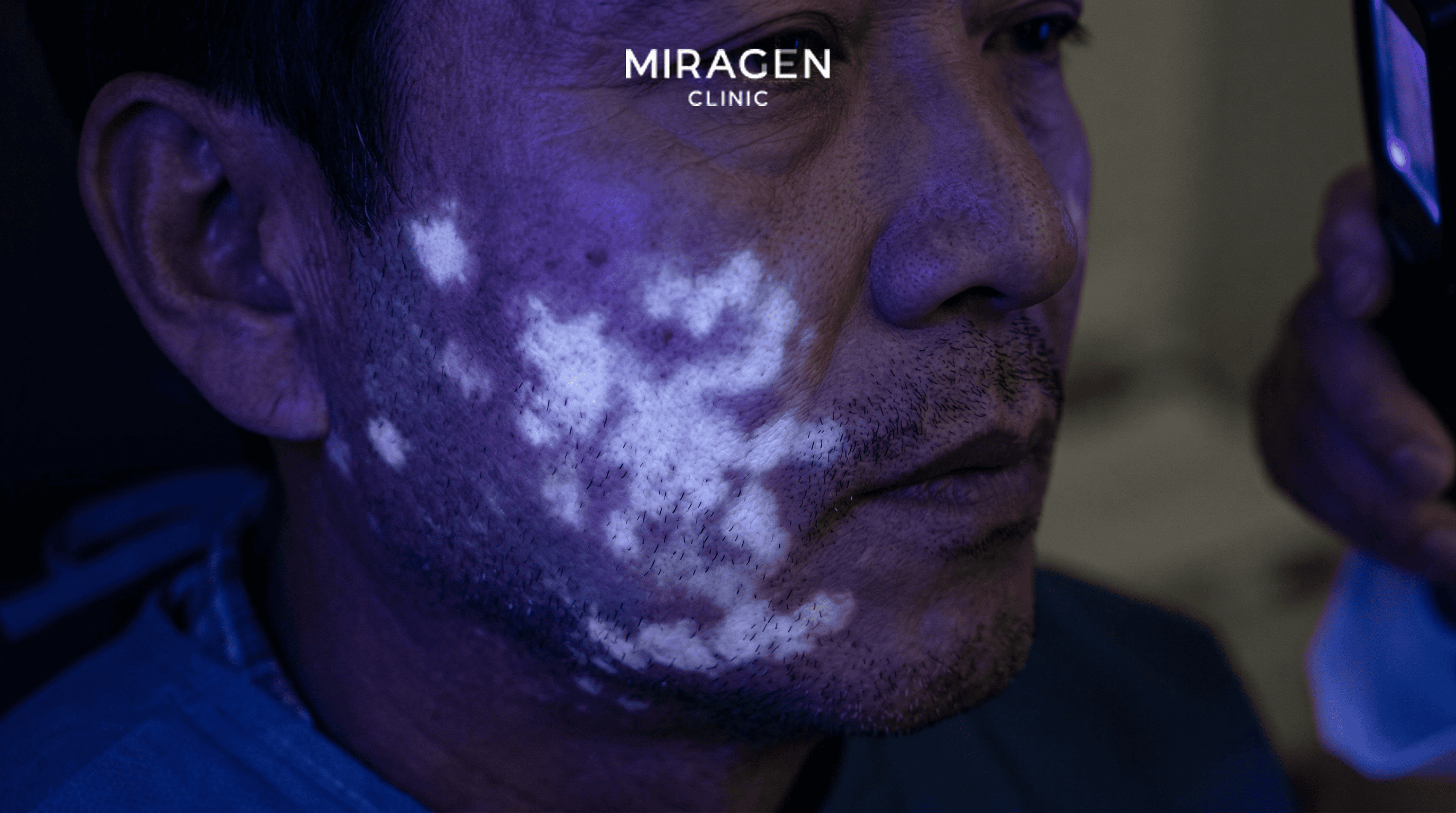 우드등(Wood lamp) 검사에서 볼 부위 피부 병변이 밝은 흰색 형광을 나타내는 모습