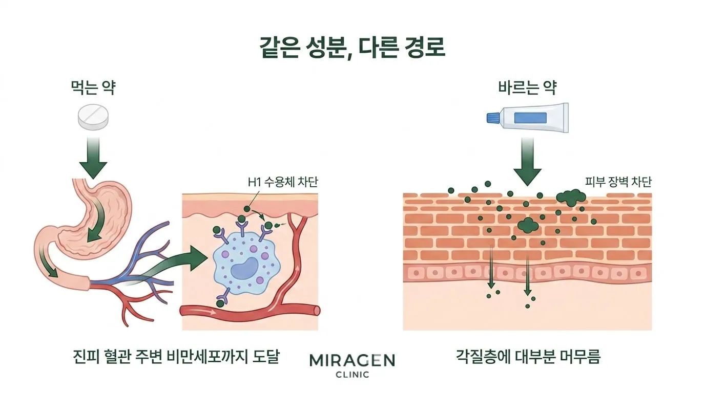 경구와 바르는 항히스타민제의 경로 차이 경구 항히스타민제는 소화관을 거쳐 진피의 비만세포 H1 수용체까지 도달해 작용하고, 바르는 항히스타민제는 각질층 장벽에 막혀 표피에 대부분 머무르는 경로 차이를 좌우 분할로 비교한 일러스트