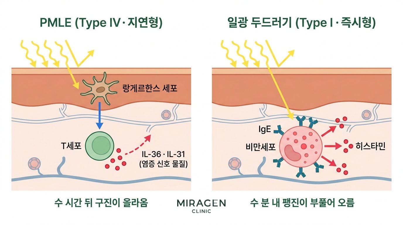 PMLE의 T세포 기전(Type IV 지연형)과 일광 두드러기의 비만세포 · IgE 기전(Type I 즉시형)을 피부 단면으로 비교한 면역 경로 일러스트.