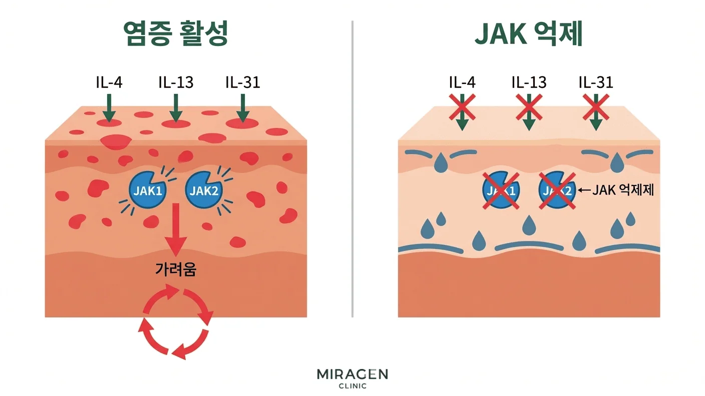 룩소리티닙 JAK 경로 억제 기전 루티닙 연고와 옵젤루라의 주성분인 룩소리티닙이 JAK1과 JAK2를 억제하여 아토피 가려움과 염증 신호를 차단하는 작용 기전을 보여주는 의료 일러스트