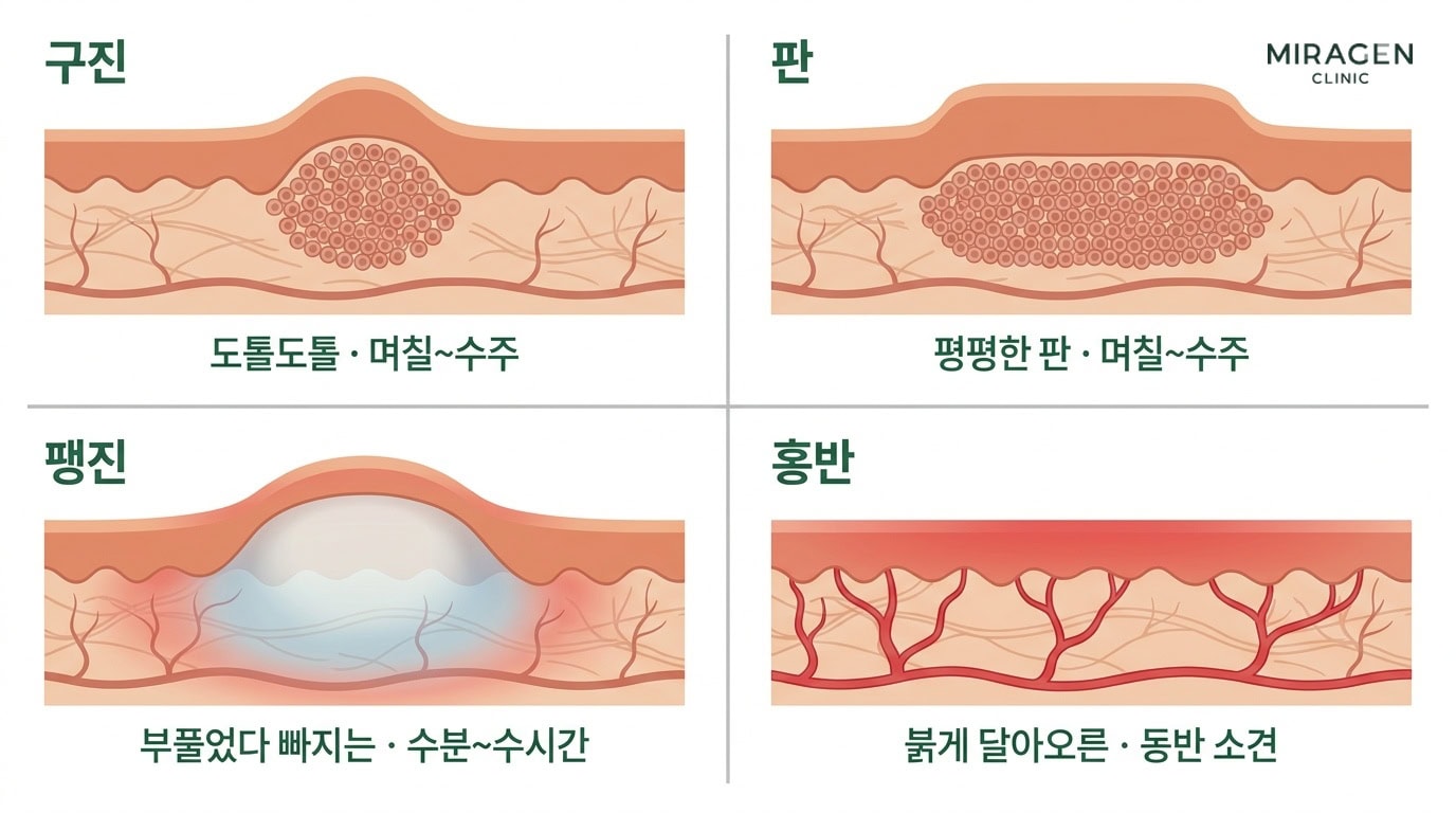 발진 용어인 구진 · 판 · 팽진 · 홍반의 피부 단면 모양과 지속 시간을 비교한 일러스트로 햇빛 알레르기 환자의 병변 유형을 구분하는 데 도움이 됩니다.