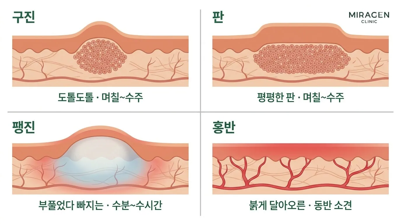発疹用語である丘疹・局面・膨疹・紅斑の皮膚断面形状と持続時間を比較したイラストで、日光アレルギー患者の病変タイプを区別するのに役立ちます。