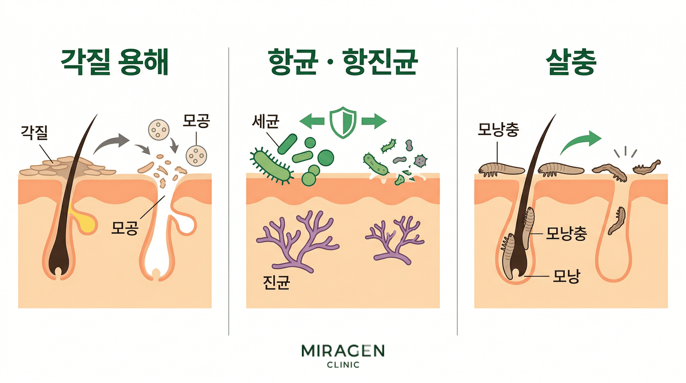 유황의 피부 3가지 작용 — 각질 용해, 항균 · 항진균, 살충 유황 성분의 피부 3가지 약리 작용 — 각질 용해로 모공을 열고, 세균과 진균 성장을 억제하며, 모낭충을 살충하는 과정을 보여주는 의학 일러스트