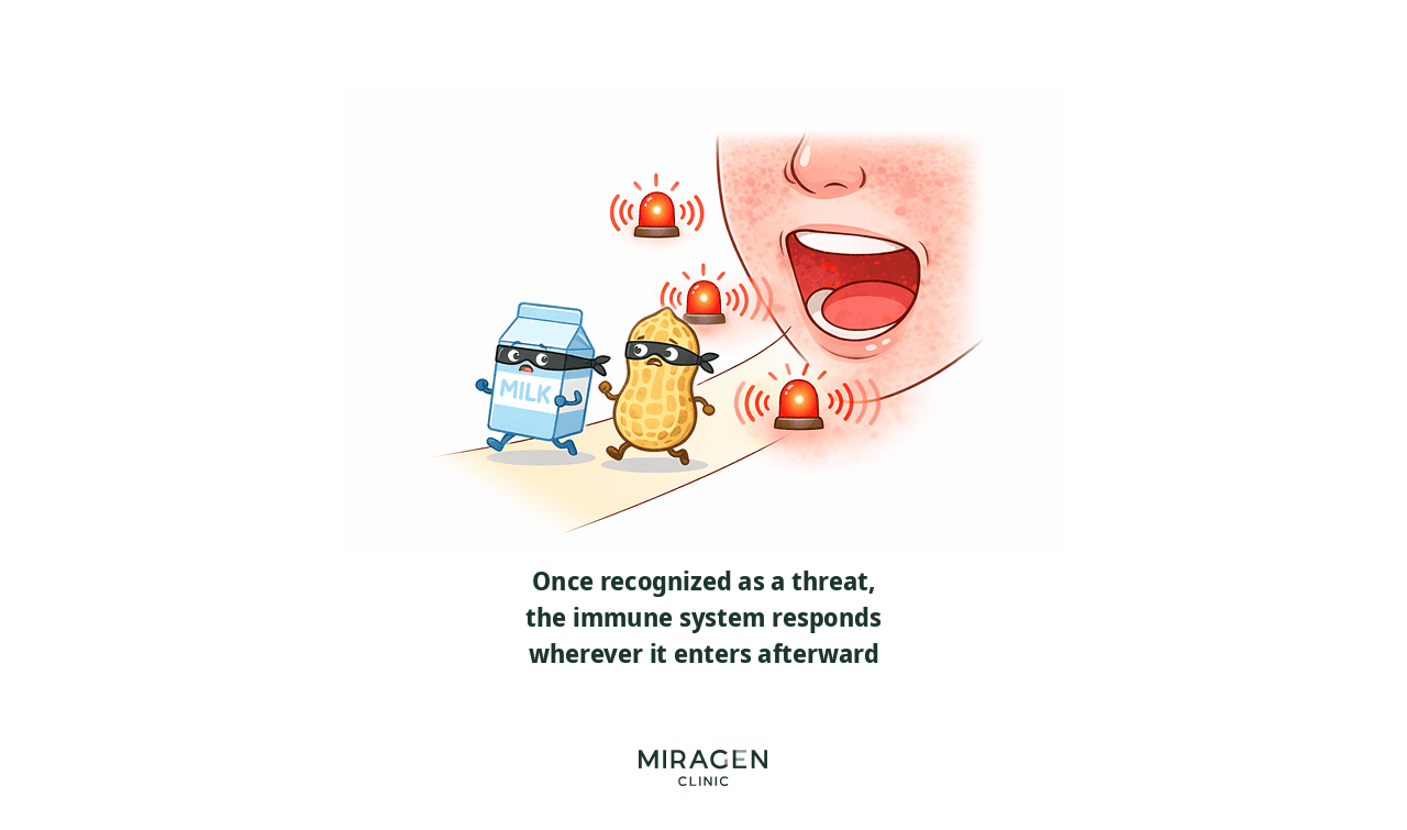 Mechanism of Allergen Immune Response An illustration depicting milk and peanuts, once recognized as the Mafia, entering through the mouth wearing burglar masks and triggering an immune alarm; it explains the process of how food allergies spread systemically after skin barrier damage.