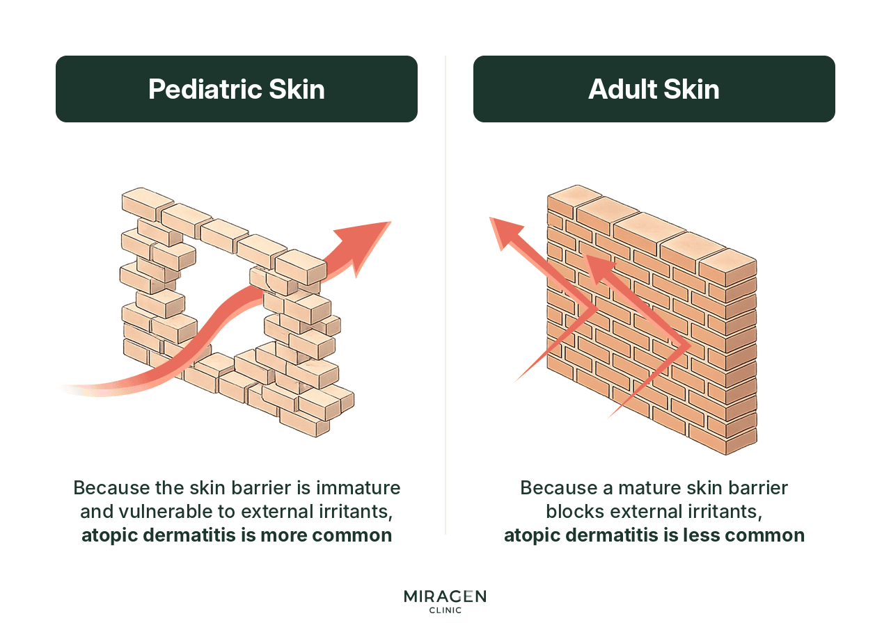 Comparison of Pediatric and Adult Skin Barriers An infographic comparing pediatric and adult skin barriers to a brick wall; it explains that atopic dermatitis is common in children because irritants easily pass through their immature barriers, while adults have a strong barrier that blocks irritants.