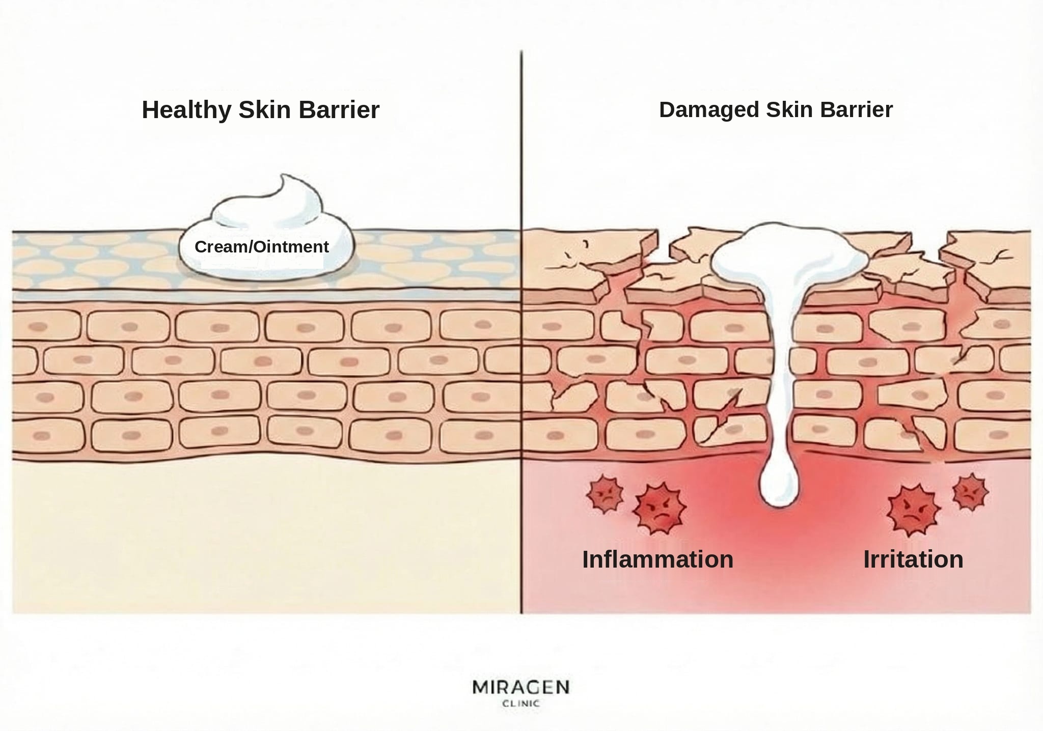 An illustration of a skin cross-section comparing the differences in topical agent penetration and irritant response in healthy vs. damaged skin barriers when using Protopic.