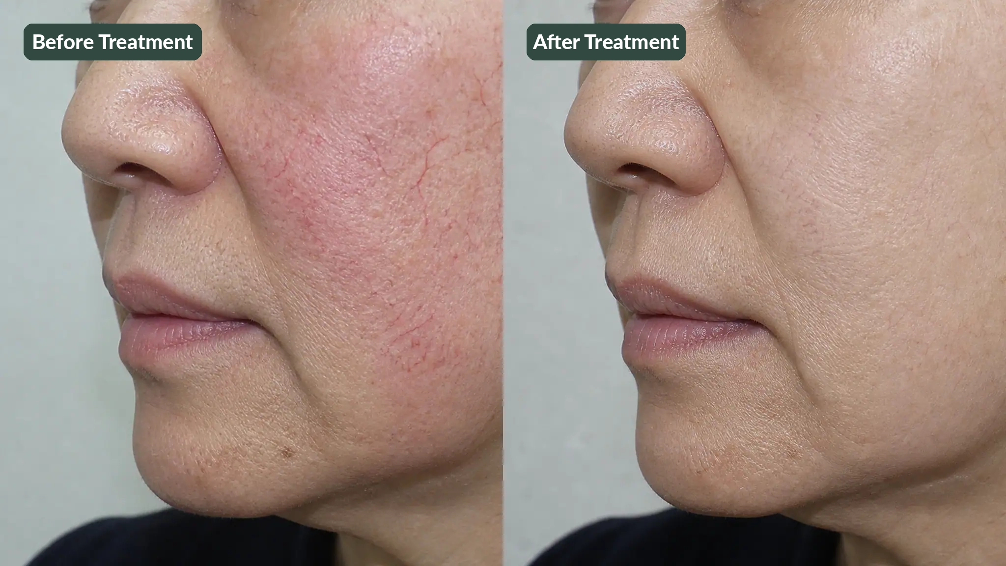 AI-generated example photo 1 showing changes in telangiectasia after Excel V treatment