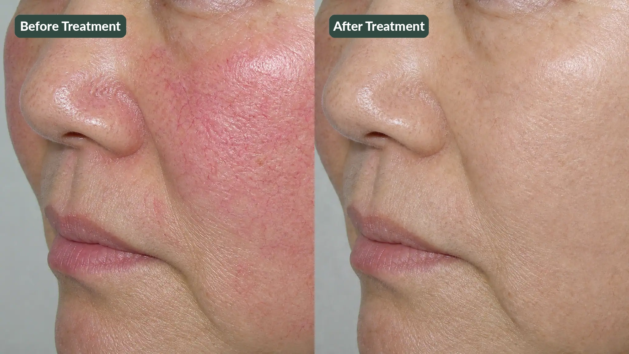 AI-generated example photo 2 showing changes in telangiectasia after Excel V treatment