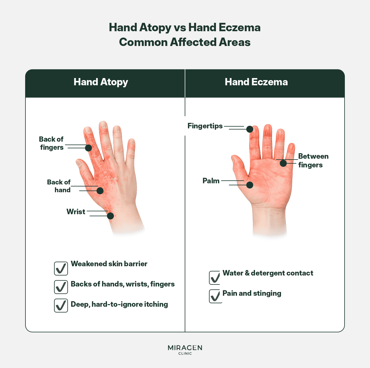 How to tell back-of-hand atopic dermatitis from housewife’s eczema