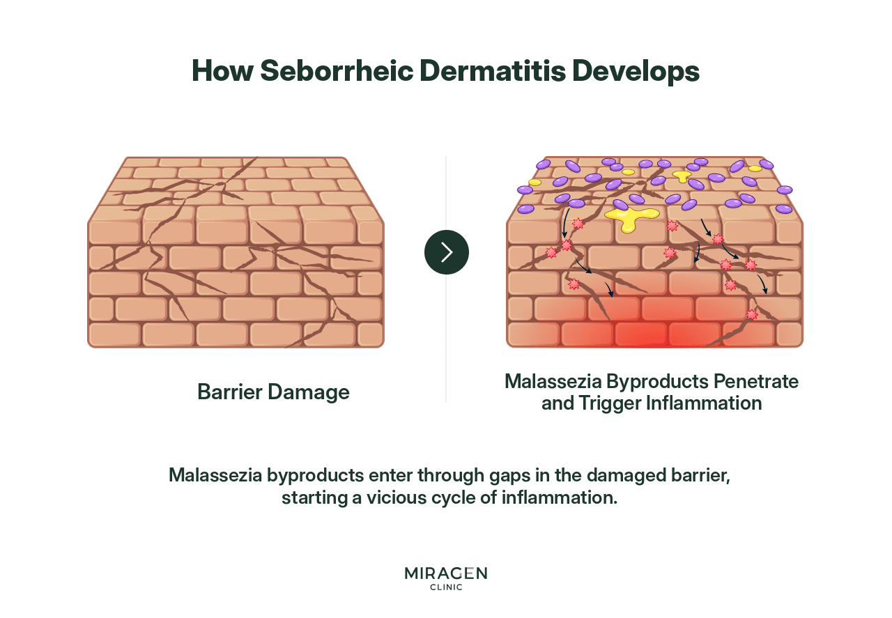 Vicious Cycle Mechanism of Barrier Damage and Inflammation in Seborrheic Dermatitis An infographic showing the step-by-step mechanism of seborrheic dermatitis, where Malassezia metabolites penetrate through gaps in a damaged skin barrier to cause inflammation, which then further damages the barrier.