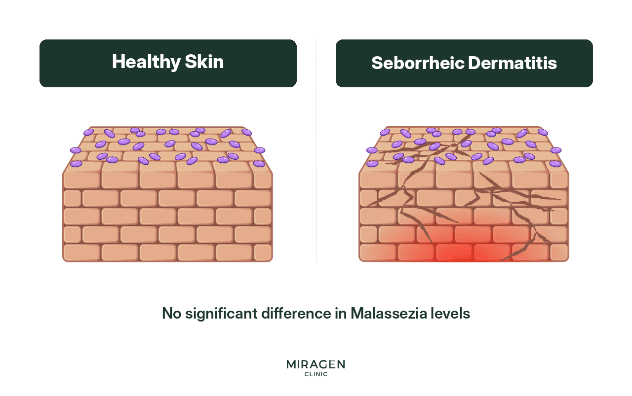 Comparison of Malassezia on Seborrheic Dermatitis vs. Normal Skin An illustration showing that there is no difference in the number of Malassezia fungi between the skin of seborrheic dermatitis patients and healthy individuals, explaining that the cause is a barrier issue rather than the fungus itself.