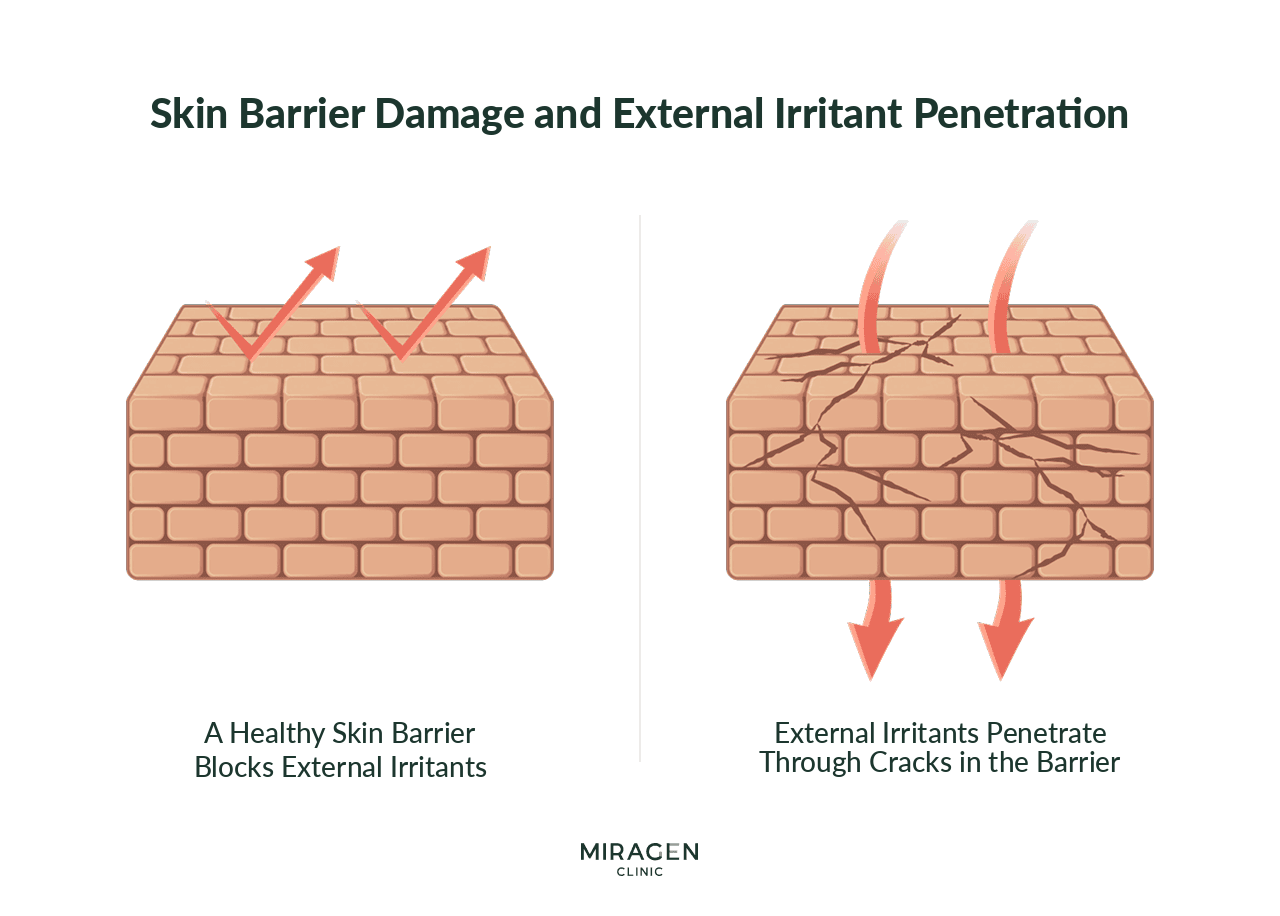 Barrier Damage and Penetration of External Irritants An infographic explaining the root cause of rosacea using a brick wall analogy — a healthy skin barrier blocks external irritants, while a damaged barrier allows irritants to penetrate through cracks, triggering inflammation.