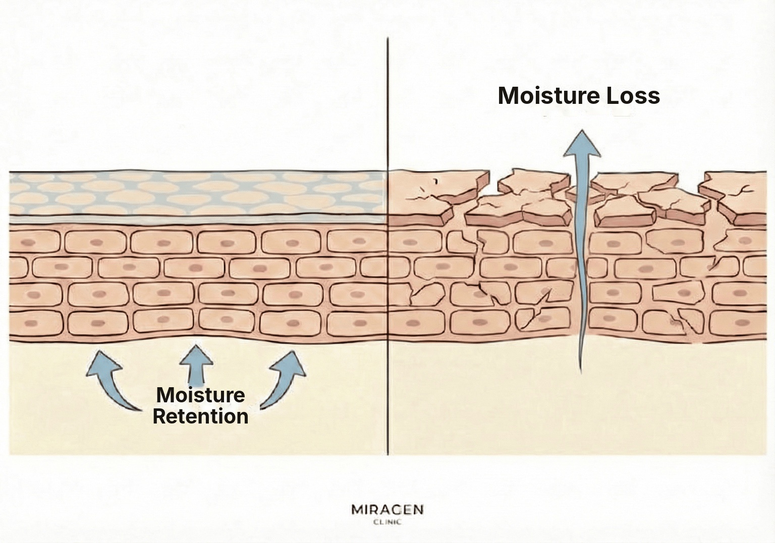 Illustration comparing a healthy skin barrier with one damaged by the high pH (9-10) of sulfur soap, showing moisture loss and dryness.