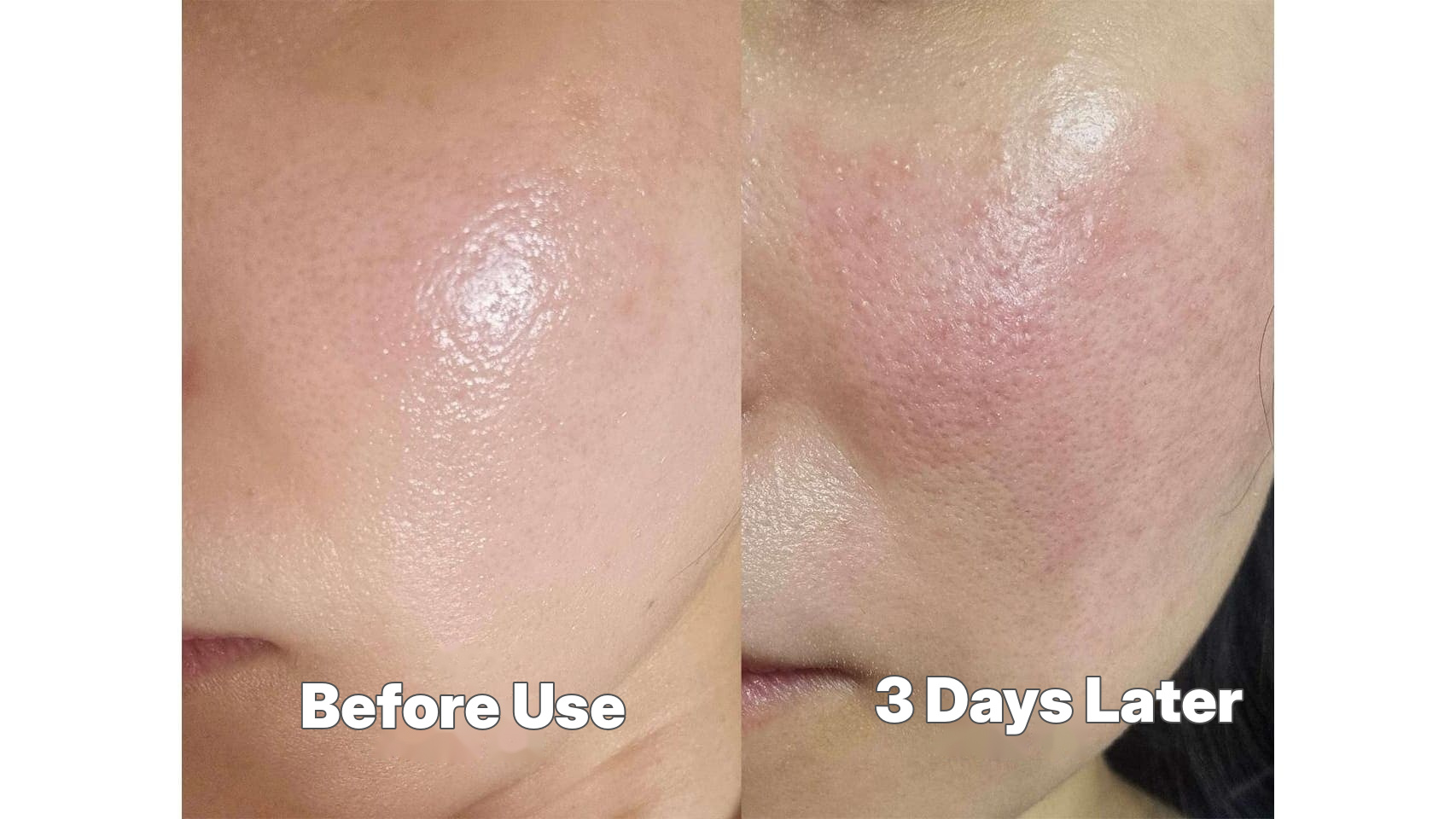 Initial flare-up 3 days after using Soolantra Clinical photos comparing the cheek area of the same patient before and 3 days after applying Ivermectin (Soolantra) cream, showing an initial flare-up reaction due to Demodex die-off.