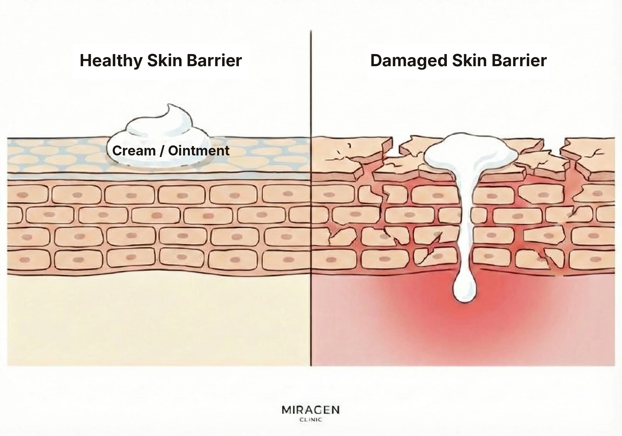 Barrier Damage and Steroid Absorption Rate Infographic showing that steroid absorption rate can sharply increase with the degree of skin barrier damage.