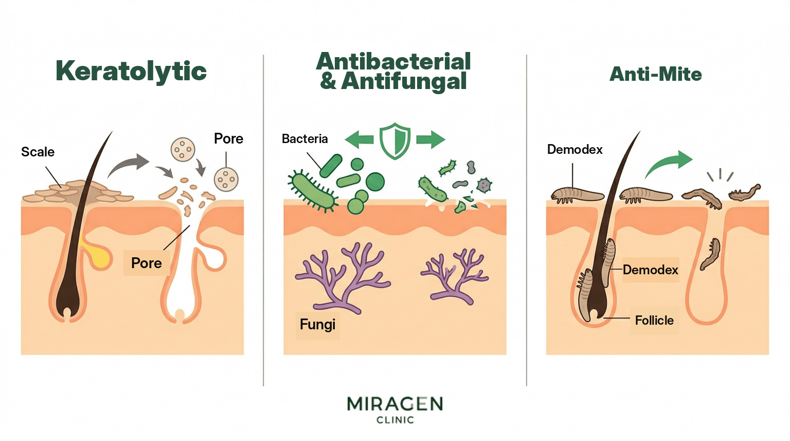 Three Actions of Sulfur on Skin — Keratolytic, Antibacterial · Antifungal, Insecticidal Medical illustration showing the three pharmacological actions of sulfur on the skin — opening pores through keratolysis, inhibiting bacterial and fungal growth, and killing demodex mites.