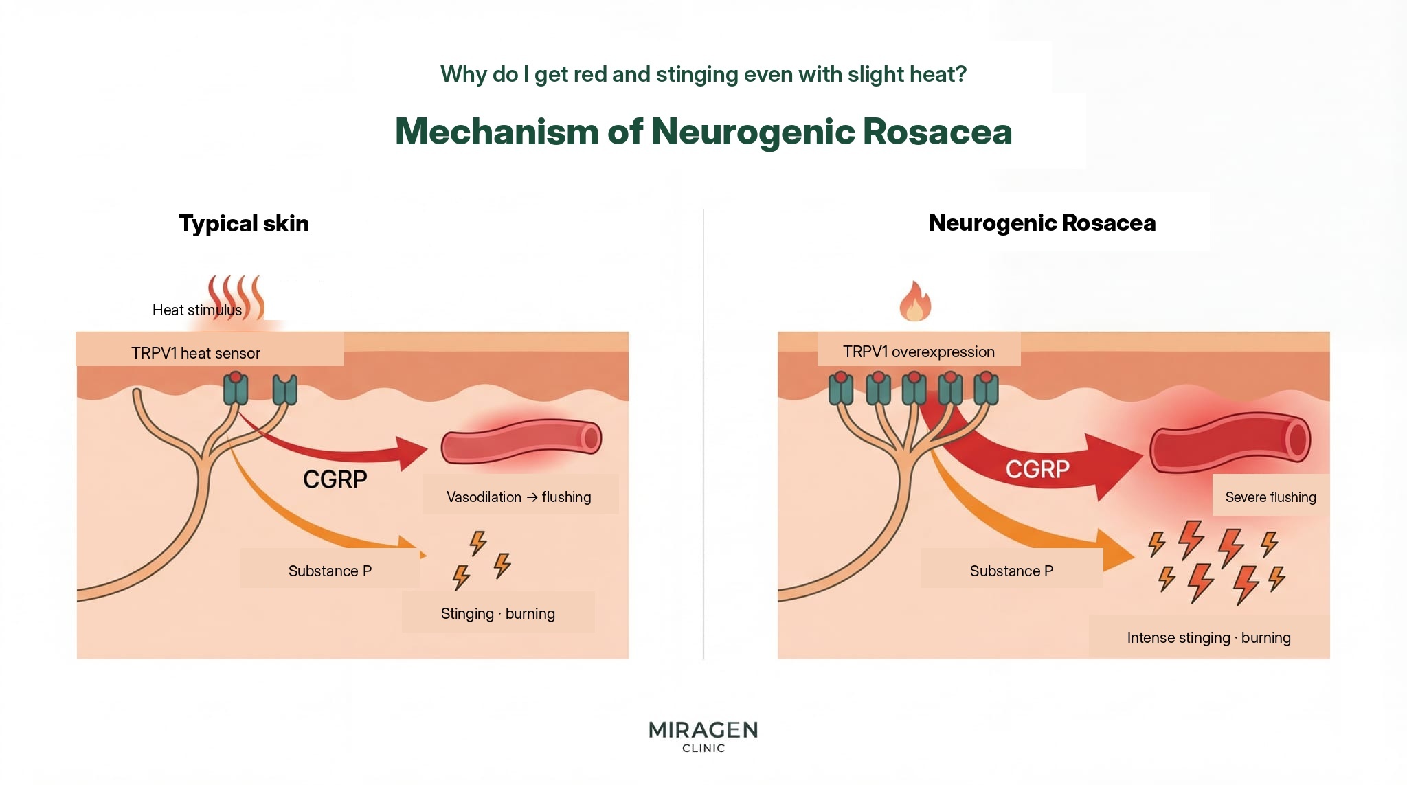 Neurogenic Rosacea TRPV1 Mechanism Diagram An illustration showing the mechanism of neurogenic rosacea. The left side compares the process where heat stimulation activates TRPV1 receptors in normal skin to release CGRP and Substance P, while the right side shows the process where much stronger flushing and burning occur in skin with TRPV1 overexpression under the same stimulation.