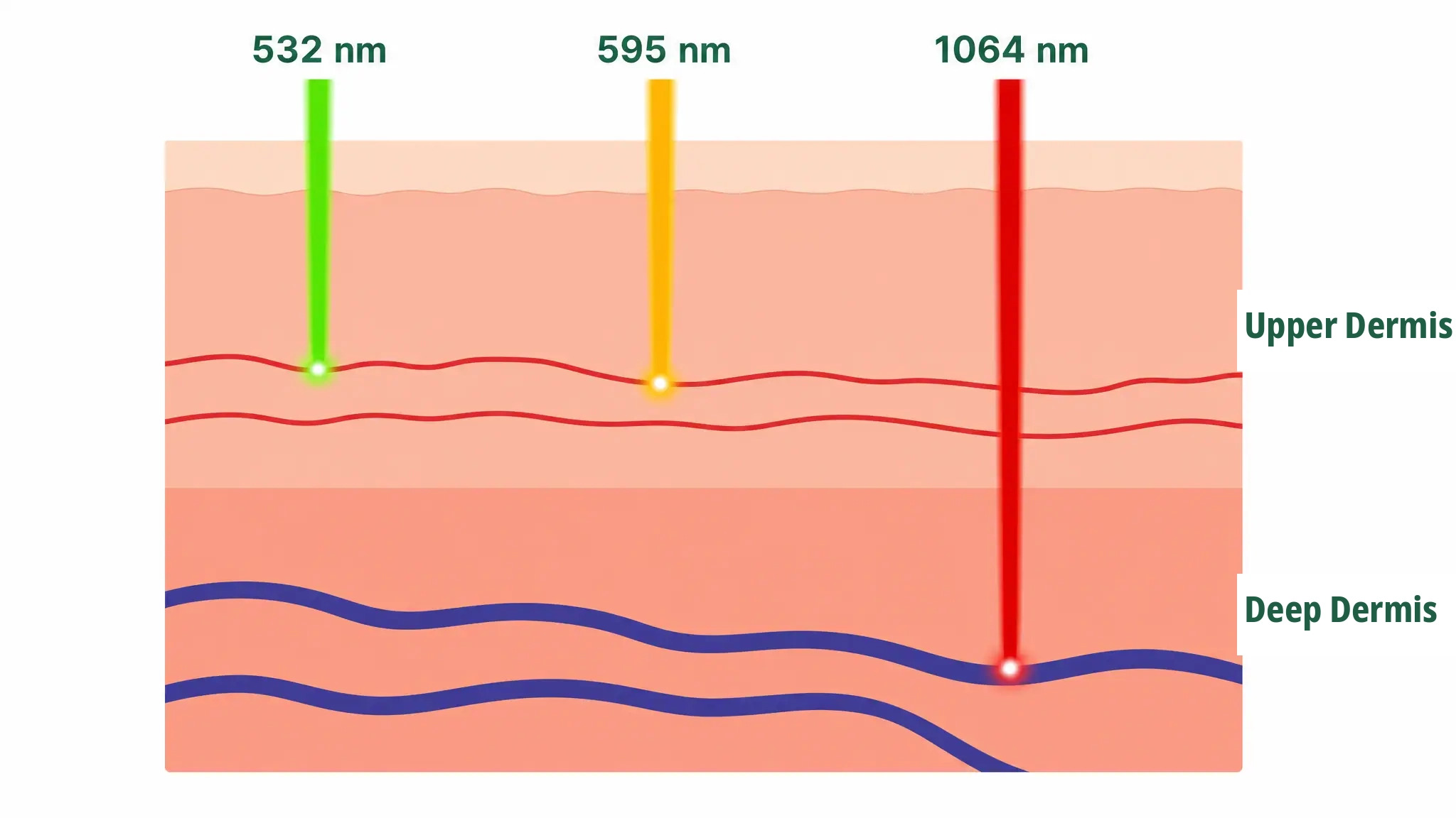 Comparison of skin penetration depth and target vessels by vascular laser wavelength Comparison illustration showing that 532 and 595 nm wavelengths reach fine red capillaries in the superficial dermis, while the 1064 nm wavelength penetrates to thick blue veins in the deep dermis