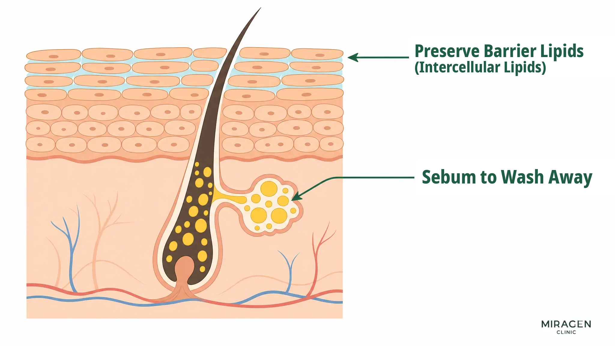Skin cross-section diagram color-coding sebum in pores (yellow droplets, oil to be washed away) and intercellular lipids filling the spaces between corneocytes (light blue, oil to be protected)