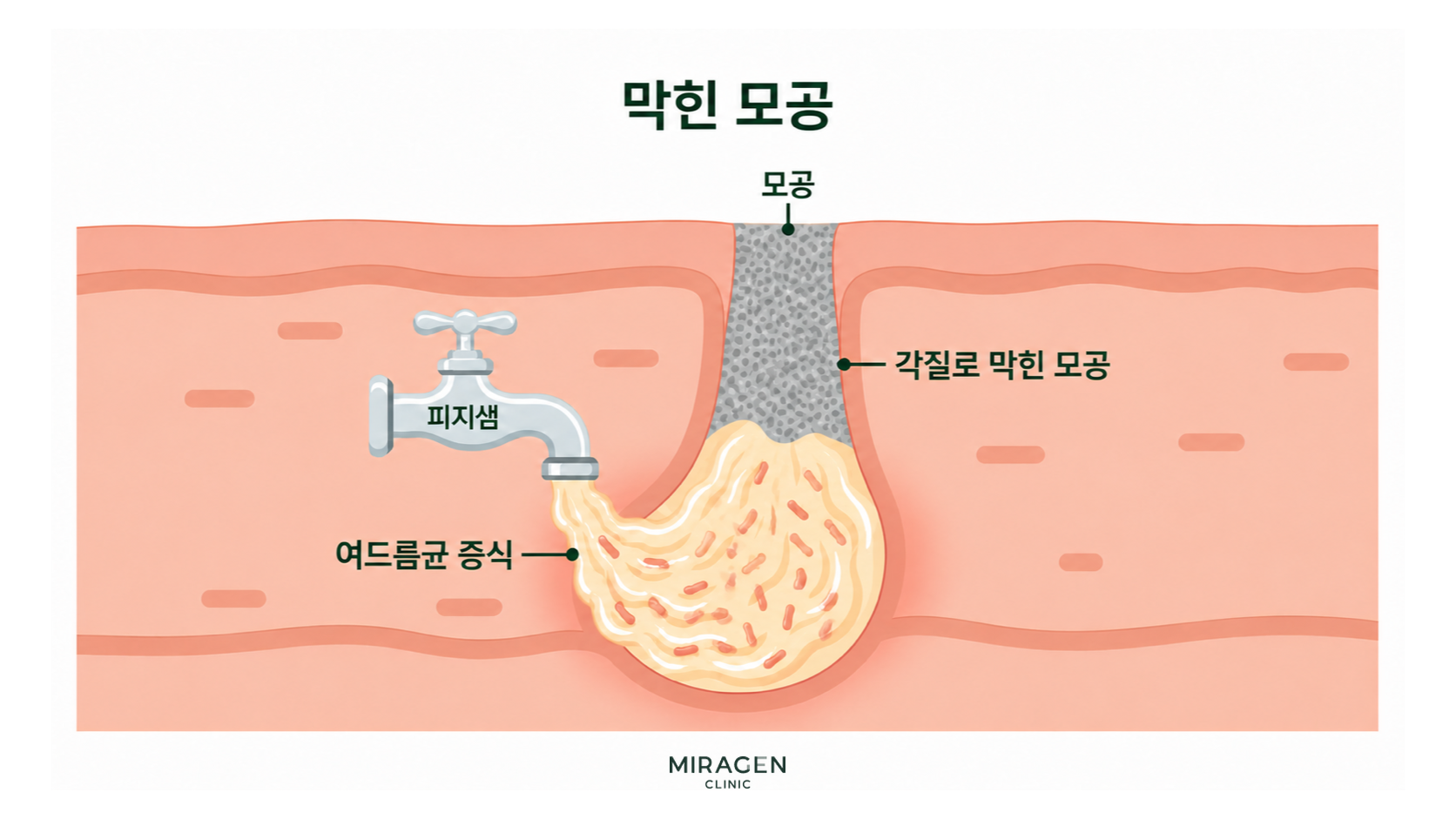 State of inflammation due to a completely blocked pore Cross-sectional illustration of a completely blocked pore showing dead skin cells blocking the pore, acne bacteria proliferating, and inflammation beginning, using a faucet analogy.