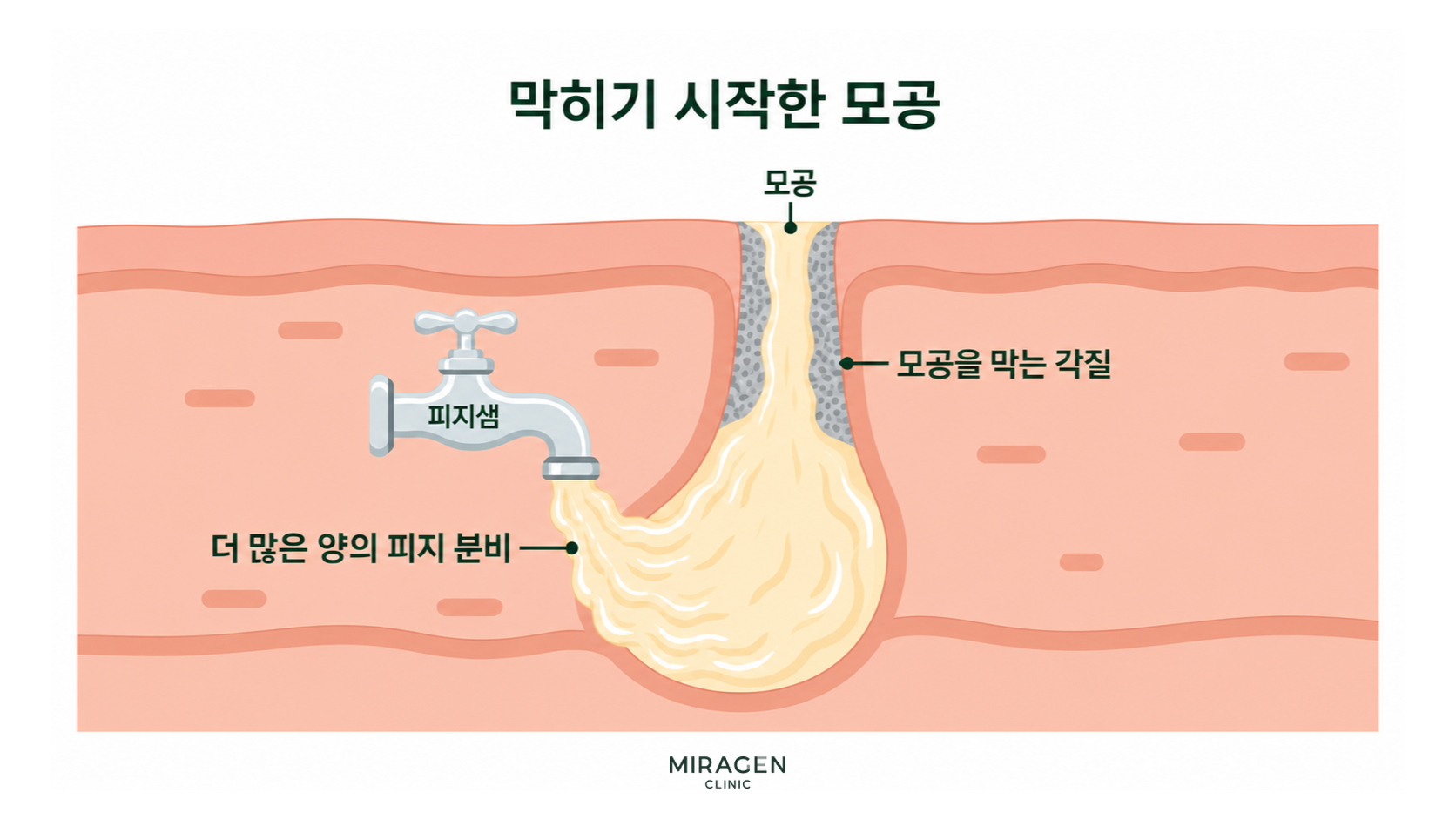 Stage where the pore begins to clog Cross-sectional illustration of a pore where acne begins to form, showing dead skin cells blocking the pore and sebum being over-secreted and accumulating, using a faucet analogy.