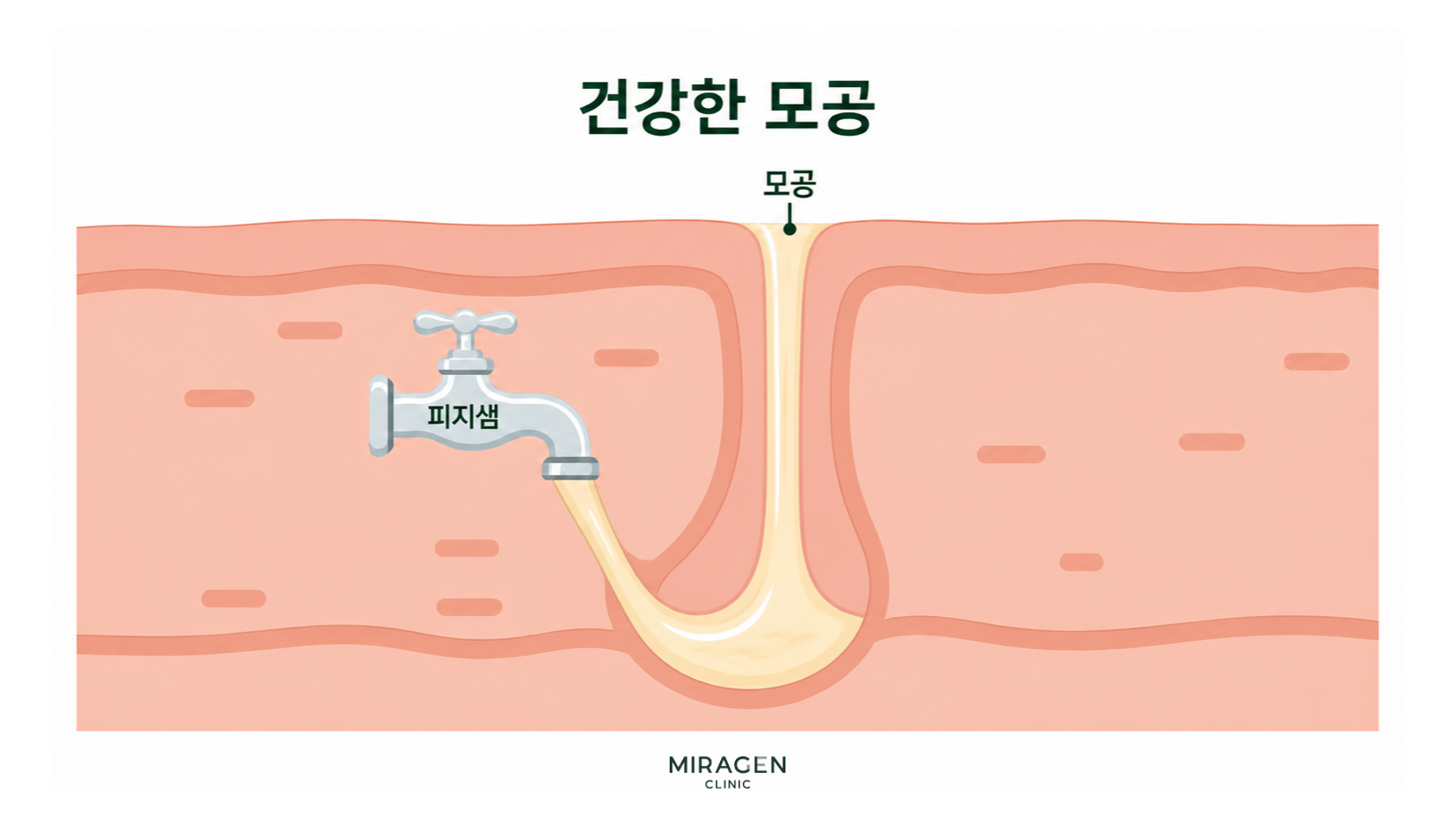 Healthy Pore — State of normal sebum discharge Cross-sectional illustration of a healthy skin pore showing sebum being normally secreted from the sebaceous gland and discharged through the pore, using a faucet analogy.