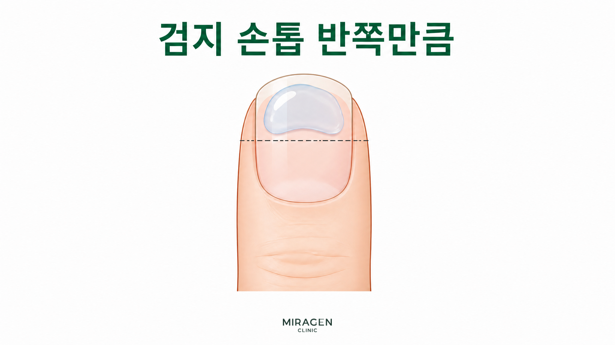 검지 손톱의 위쪽 절반에 해당하는 양만큼 투명한 겔을 올리고 점선으로 사용량의 기준을 표시해 디페린겔을 보습제와 섞을 때의 시작 용량을 보여주는 그림입니다.