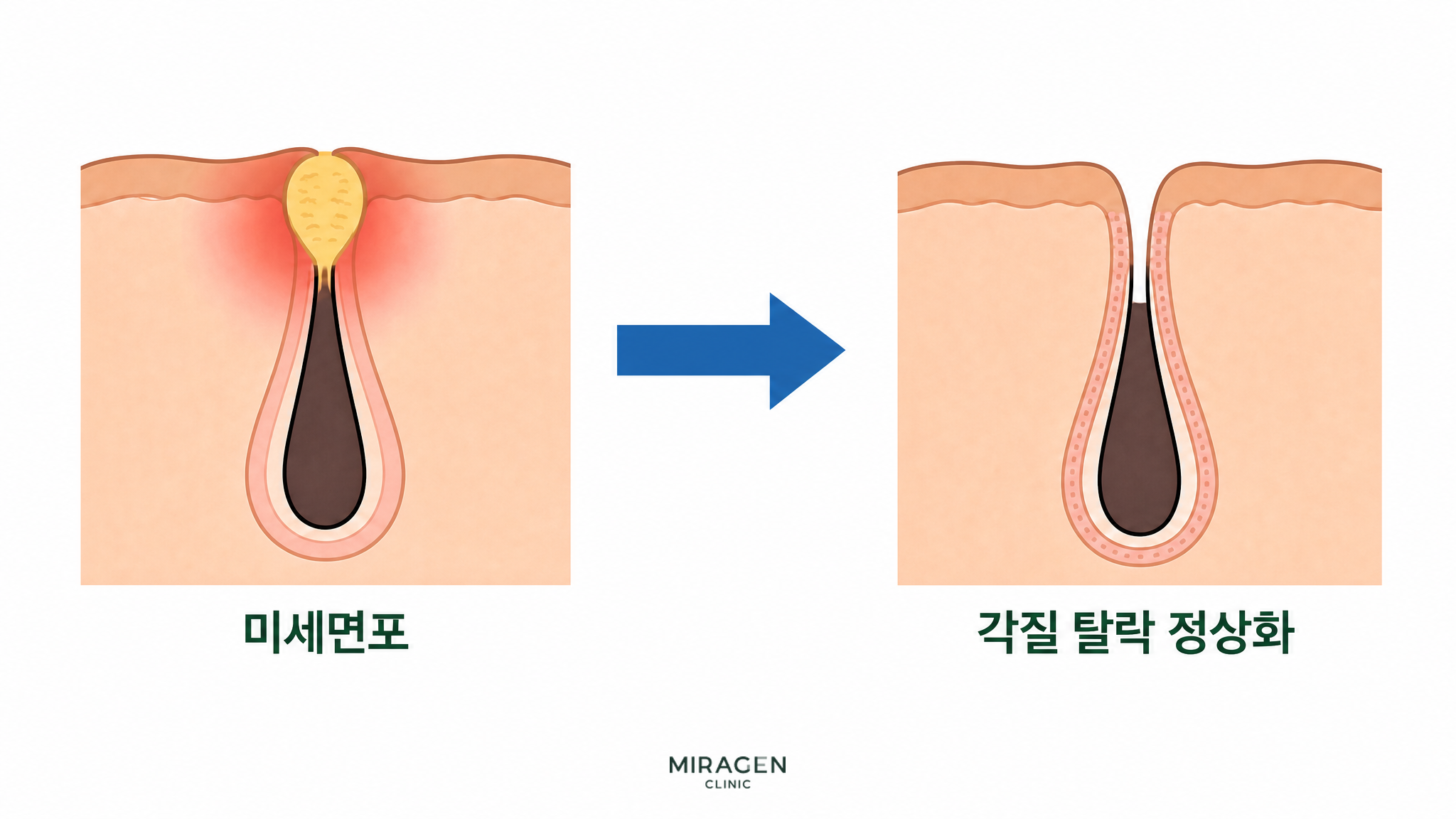 각질로 막힌 모공의 미세면포가 디페린겔 작용으로 정리되고 모공 입구가 열리면서 각질 탈락이 정상화되는 변화를 전후 피부 단면으로 비교해 보여주는 그림입니다.