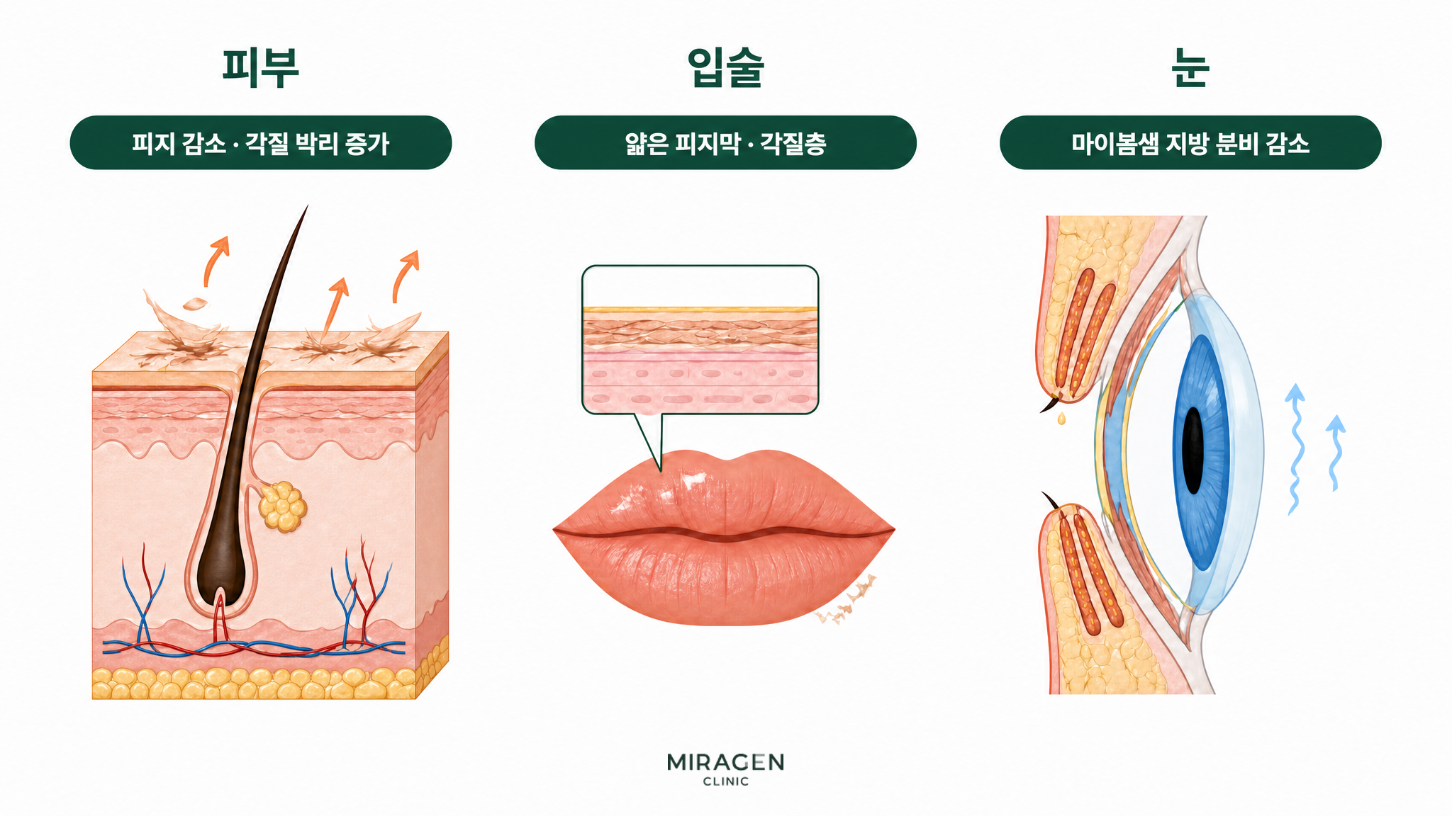An illustration showing the drying process after taking Isotretinoin, including reduced sebum, increased exfoliation, thinning of the sebum film and stratum corneum on the lips, and decreased lipid secretion from the meibomian glands in the eyes.